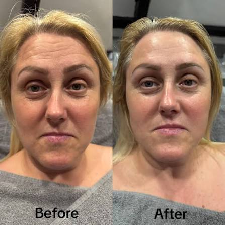 Before and after using Ecloria Beauty